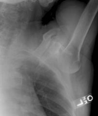 inferior dislocation of the glenohumeral joint AKA luxatio erecta
closured reduction and immobilization however if in a young active patient surgical arthroscopy with reconstruction of the labral
Rotator cuff tear
Axillary nerve palsy which usuall...