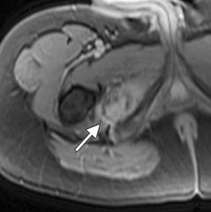 A 25-year-old male presents complaining of a groin mass which he noticed after a football injury. He states he was struck in the groin with an opposing player's helmet during a tackle and had a large amount of bruising and pain. While his pain and...