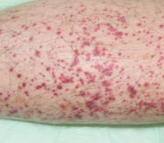 small purplish hemorrhage spots on skin