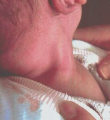A 6-week-old female infant presents with the neck deformity and palpable mass shown in Figure A. She has had persistent lateral tilting of her head to the right since birth, and rotation of the neck is restricted. In this age group, what is the mo...