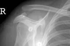 what the diagnosis
What is the best diagnostic studies to confirm the diagnosis on x-ray what other x-ray views helpful if the differential can includes a fracture of the coracoid
which ligament provides horizontal stability
Which ligament provide...