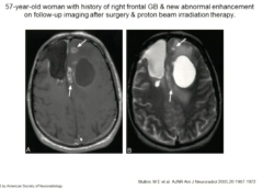 Development Satellite Lesions Ependymal Enhancement Suggest Tumor Recurrence