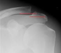 what the diagnosis based on classification
Describe this type of injury including what is torn
What is the treatment 
treatment professional athlete