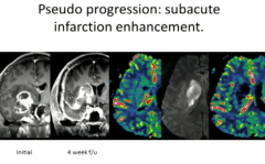 Pseudo Progression:
Subacute Infarction Enhancement