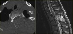 posterior spine – differential diagnosis osteoid osteoma/osteoblastoma & sacral eccentric, MA-ABCG
bubbly apparent – expansile eccentric and lytic lesion with bone septae classic cases with thin rim of periosteal new bone surrounding lesion n...