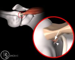 glenohumeral instability
Internal impingement which is abutment of the greater tuberosity against the posterior superior bone or joint abduction and external rotation
SLAP lesion 25% 
retroversion of the glenoid