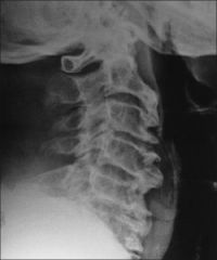  with a canal diameter all Spirit tackler spine AKA cervical stenosis with a canal diameter of <13 mm normal 17 mm or torque PAVLOV ratio < 0.8 normal 1.0
retire  AKA contraindication to return to play
MAY remove facemask to protect airway or d...