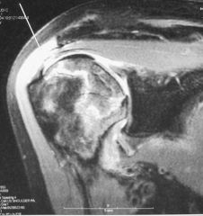 AVN  of the humeral head
Treatment is 100% dependent upon the stage of the disease
MRI to determine edema and site of subchondral sclerosing