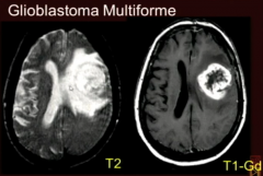 Cannot Have Any Vascular Change in Anaplastic Astro Who III
So anyenhancement Perfusion Change of diffuse astrocytoma is GBM WHO IV