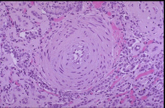 Hyperplastic Arteriolosclerosis. Increased number of SM cells in a concentric arrangement.