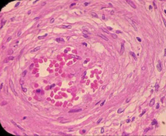 Hyperplastic Arteriolosclerosis. Note laminar arrangement in vascular wall, “onion skin lesion”.