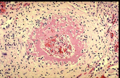 Fibrinoid Necrosis. Inflammatory cells are present, so this is necrotizing  arteriolitis.