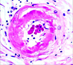Maternal vessel in HTN as part of eclampsia.