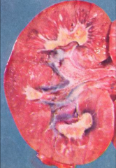 Papillary necrosis in a case of diabetes. Yellow areas represent necrosis of the papillae.
