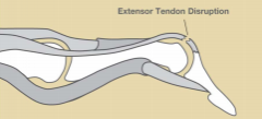 1. definition 
- Injured through passive DIP flexion with resisted extension
- May involve a fracture
2. Mx
- Immobilise DIP in 5-15° hyperextension with PIP jt free for 6-8/52
- ROM of unaffected joints
- At 8/52 commence gentle DIP F