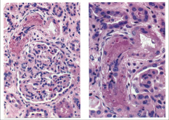 HEMOLYTIC UREMIC SYNDROME (FIBRINOID NECROSIS OF HILAR ARTERIOLE). Irregular pinkish areas represent fibrinoid necrosis.