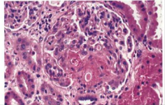HEMOLYTIC UREMIC SYNDROME. Fibrinoid necrosis visible within the glomerulus.
