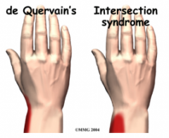 1. 1 CMC jt OA
2. Intersection syndrome
3. Wartenburg’s Syndrome

1. distal radius #
2. FCR/ECR strain
3. scapholunate dissociation