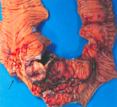 Crohn's Disease
- Transmural inflammation → fistulas
- Cobblestone mucosa, creeping fat, bowel wall thickening, linear ulcers, fissures