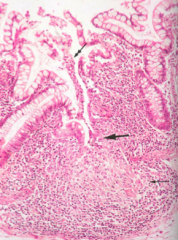 What is this pathology associated with?