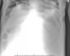 - Gas in abdomen = pneumoperitoneum
- Liver falls away on upright film