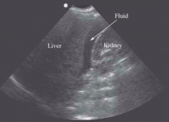 Look for fluid between liver and kidney