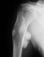 A 21-year-old male presents with increasing shoulder pain for the past 6 months. Radiograph, CT scan, bone scan, MRI, and histology slide are shown in Figures A through E. What is the most appropriate diagnosis? 
1.  Ewing's sarcoma
2.  Perioste...