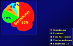 Pineal Germ Cell
1. Germinoma 65%
2. Teratoma 18%
3. Other