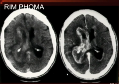 RIM PHOMA
primary cns lymphoma extends along surface ventricular surface