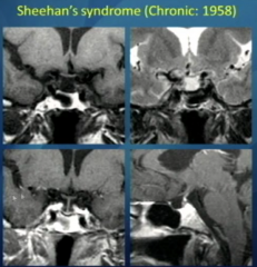 Sheehan
Chronic
May Present Chronic Endocrine
May Present With Empty Sella