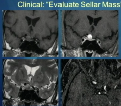 Clinical History:
Evaluate "Sella Mass"
 
 
Aneurysm!!!