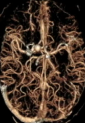 Not Bright on MRA source Image--
but Positive on CTA for Aneurysm