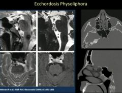 Ecchordosis Physoliphora-
Small Posterior Bar on CT exam