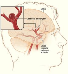 Intracranial aneurysm
