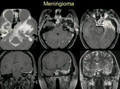Skull BaseMeningioma
In this location May Have Spiculated Appearance on Bone- With Expansion of bone-- think meningioma instead or malignant process