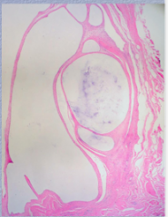 What is the term for these spaces? Do they contain an epithelial lining? Mixoid material? 
 
Degenerative phenomenon in _______ or other connective tissue near _________.