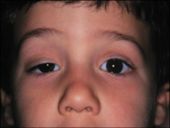eyelid abnormality due to oculomotor nerve damage
