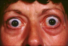 Eyelid abnormality due to hyperthyroidism.
