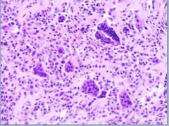 What cells do you see? Background of what that resembles what? 
 
What is this a localized type of?