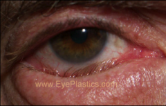 eyelid abnormality seen in geriatric patients where the lower or upper lid retracts and lashes rub up against sclera.