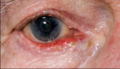 eyelid abnormality where eyelids fall outward. Very common to get dry eye.