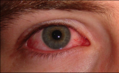 Pink or red eye that can be unilateral or bilateral.