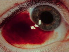 Looks like the picture. Blood in the conjunctiva.  Caused by trauma, vomitting, forceful coughing especially if on blood thinners. Takes time to heal.