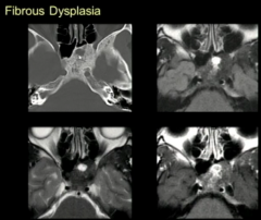 Fibrous Dysplasia
May Be A Challenge in Skull Base (Cystic Change)
10-25% Monostotic FD Affects Skull and Face Bones
>50% in Polyostotic