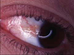 A triangular area of yellow tissue in the eye that is due to constant dry eyes.