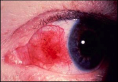 Redness or inflammation on medial cantus side of eye.