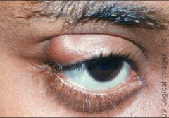 It is a lump or cyst under the eyelid (NOT on the margin) that can be caused by recurrent sty's.