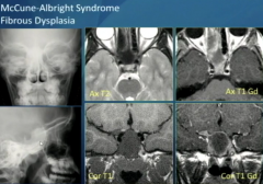 McCune-Albright Syndrome
Fibrous Dysplasia
1. Polyostotic
2. Cafe Au Lait Spots
3. Autonomous Endocrine Hyperfunction