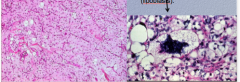 What are the three morphologic types of liposarcoma? Which two types are shown here?