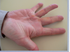 What is the term for a fixed flexion contracture of 4th and 5th finger tendons and palmar aponeurosis?
What is plantar fibromatosis? What is superficial fibromatosis?